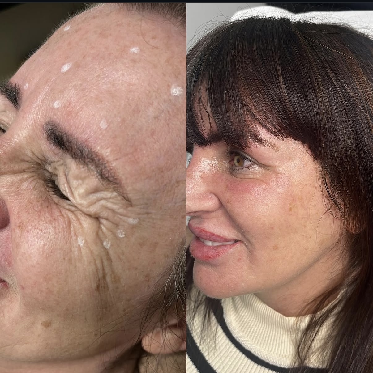 Anti-wrinkle treatment result